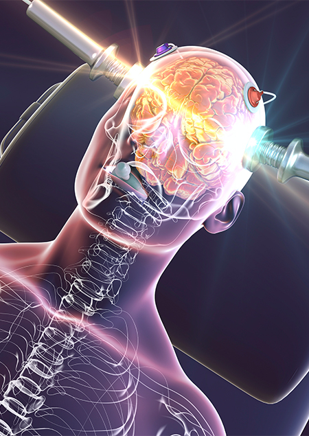 Depressão: Electroconvulsivoterapia